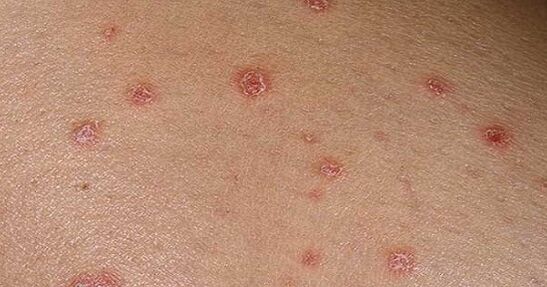 Placas psoriáticas