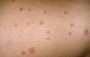 Placas psoriáticas