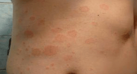 Psoríase desafortunada