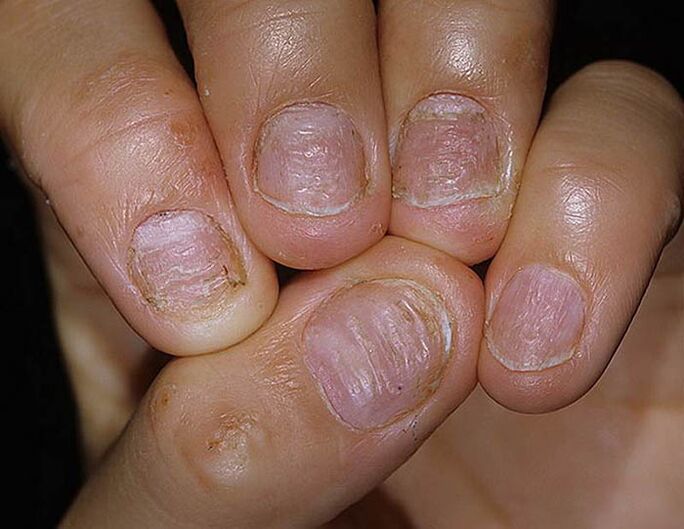 Psoríase das uñas