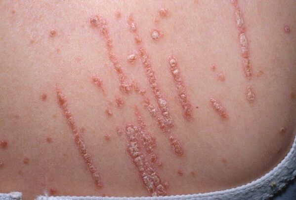 Psoríase no corpo