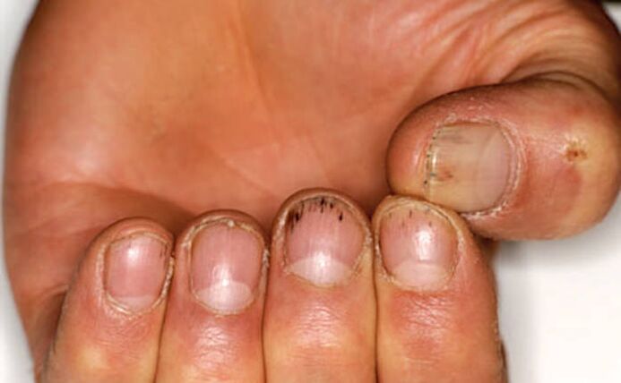 Hemorraxia baixo as uñas con psoríase