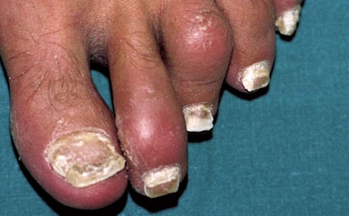 Psoríase con afectación das uñas e inflamación articular (artrite) dos dedos dos pés